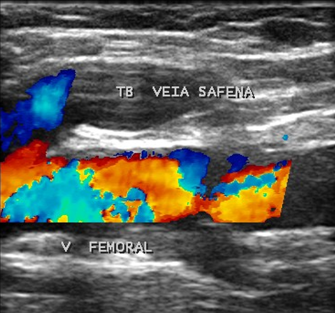 Caracterização do trombo venoso utilizando a ultrassonografia vascular